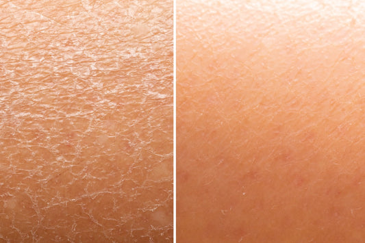 What Is the Difference Between Dry and Dehydrated Skin?