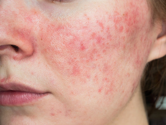 Your Skin's Moisture Barrier - How Can You Strengthen It?
